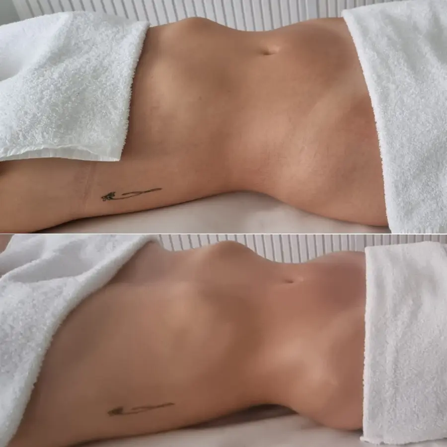 Resultado de tratamiento corporal, imagen 19 (sin identificar a la persona)