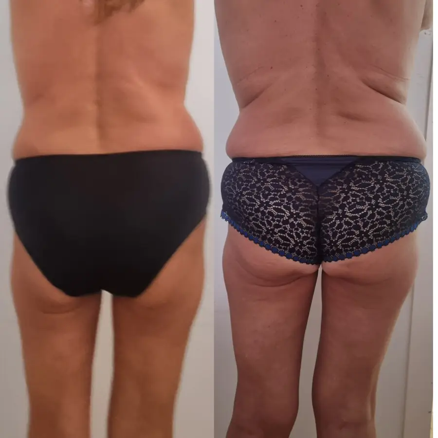 Resultado de tratamiento corporal, imagen 22 (sin identificar a la persona)