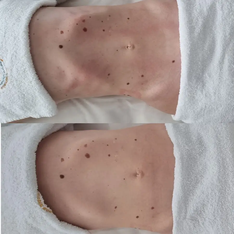 Resultado de tratamiento corporal, imagen 27 (sin identificar a la persona)