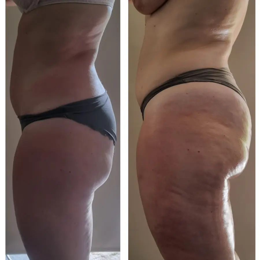Resultado de tratamiento corporal, imagen 38 (sin identificar a la persona)