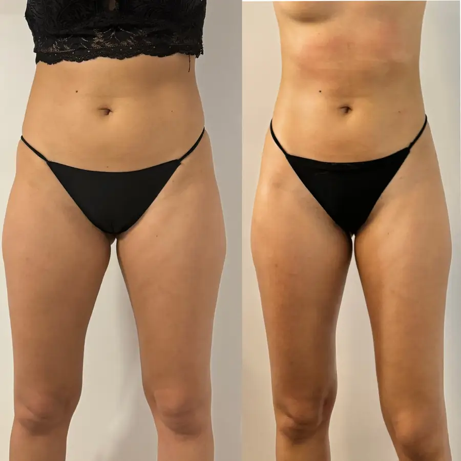Resultado de tratamiento corporal, imagen 46 (sin identificar a la persona)