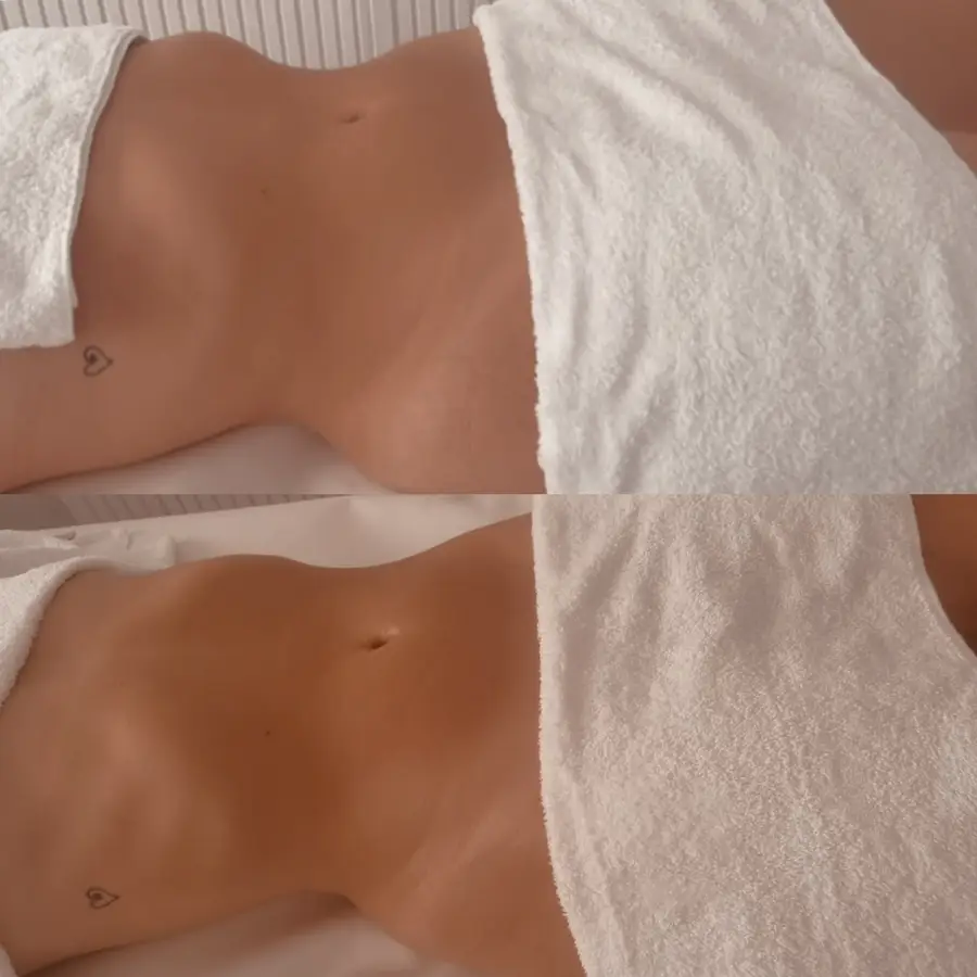 Resultado de tratamiento corporal, imagen 49 (sin identificar a la persona)