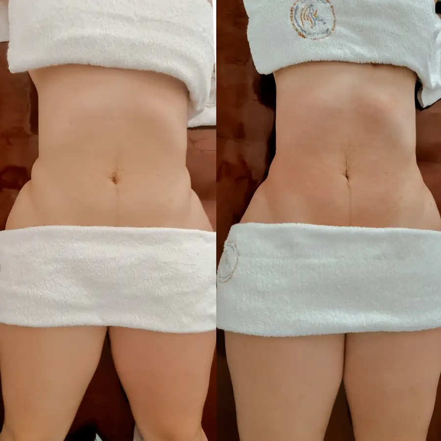 Resultado de tratamiento corporal, imagen 71 (sin identificar a la persona)
