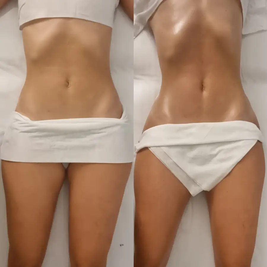 Resultado de tratamiento corporal, imagen 78 (sin identificar a la persona)