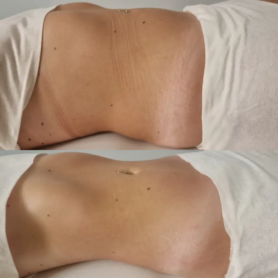 Resultado de tratamiento corporal, imagen 79 (sin identificar a la persona)