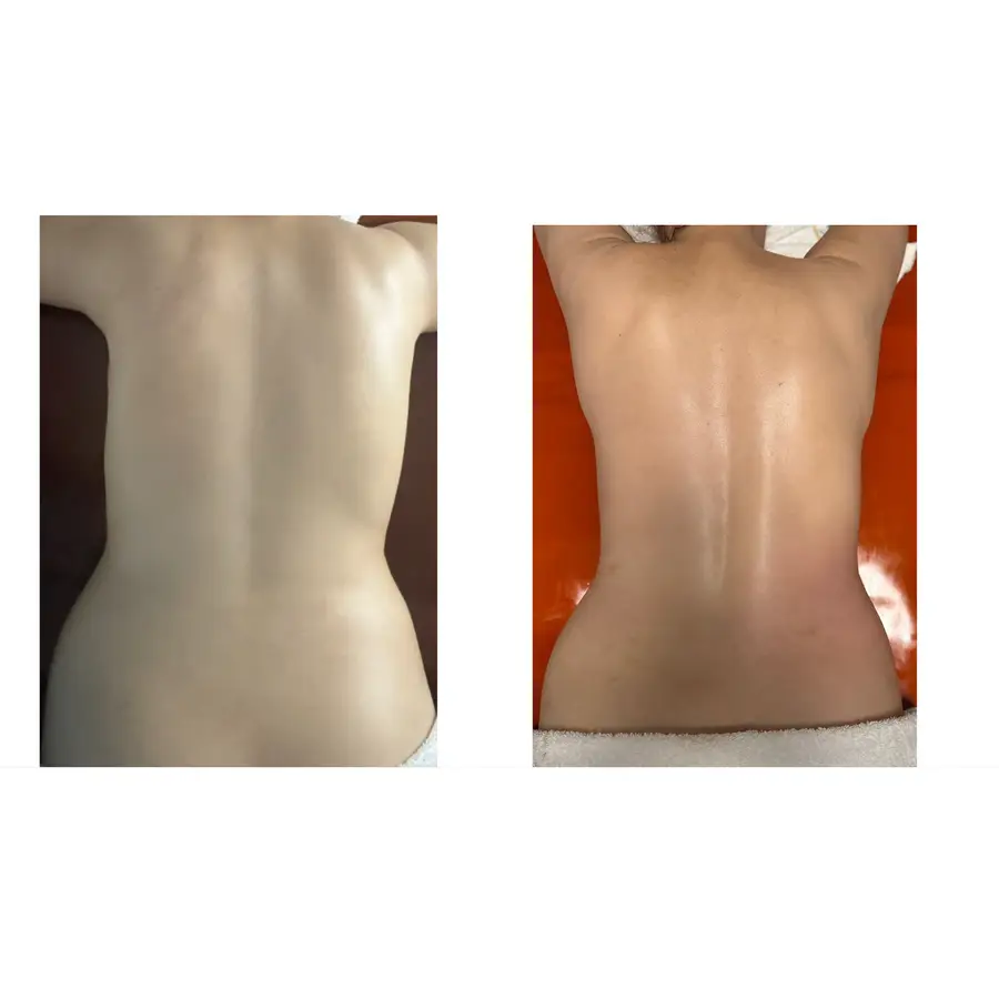Resultado de tratamiento con el método Martele, imagen 93 (sin identificar a la persona)